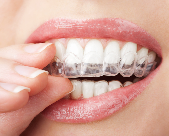 Invisalign Zahnschienen gegen Zahnfehlstellungen in Kiel